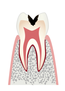 歯の内部（象牙質）まで進行した虫歯