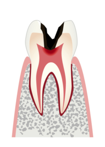 神経（歯髄）まで進行した虫歯